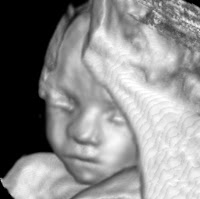 3d Ultrasound Pregnancy1