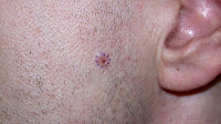 Ulcerative Basal Cell Carcinoma