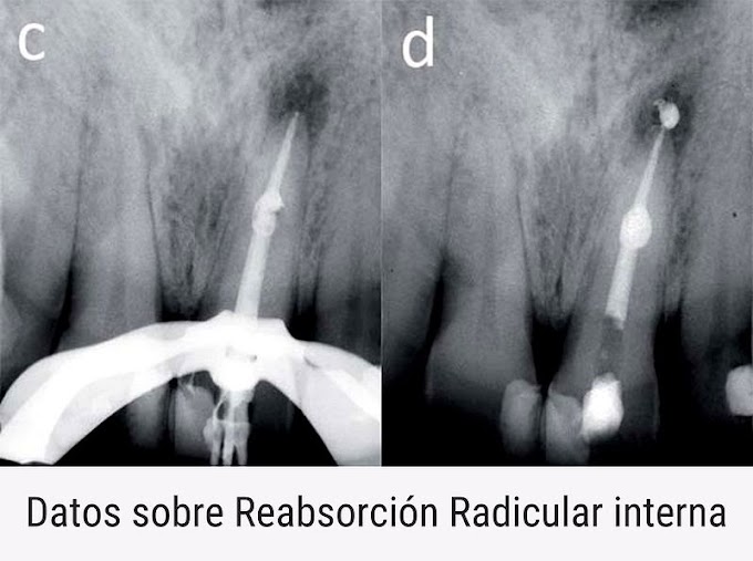 PDF: Datos sobre la Reabsorción Radicular interna