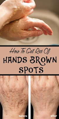 How To Get Rid Of Hands Brown Spots