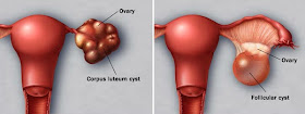 cyst, jenis cyst, sista ovari, ovary cyst, dermoid cyst, luteal cyst, endometriosis,