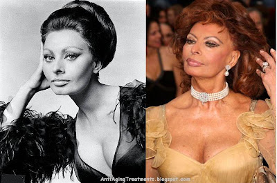 Sophia Loren Plastic Surgery