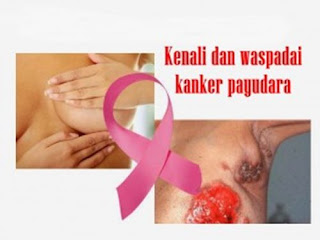 tingkat kesembuhan kanker payudara stadium 3, kunyit putih obat kanker payudara, cara mengobati kanker payudara yang sudah pecah, ramuan herbal kanker payudara, obat kanker payudara yang paling ampuh, obat alami buat kanker payudara, obat manjur untuk kanker payudara, www.obat kanker payudara, kanker payudara bagi pria, kanker payudara pada lelaki, obat kangker payudara yg ampuh, gejala kanker payudara stadium 4, www.kanker payudara stadium 4, penyebab kanker payudara laki-laki, obat k-link untuk kanker payudara, obat kemo kanker payudara, gejala awal yang dirasakan penderita kanker payudara, cara pengobatan gejala kanker payudara, kanker payudara estrogen, kejadian kanker payudara di indonesia, resiko kanker payudara stadium 3, obat alami mencegah kanker payudara, kanker payudara parah, obat kanker payudara setelah operasi, jurnal pengobatan kanker payudara, obat kanker payudara, obat jawa kanker payudara