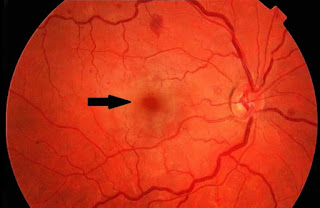 Short cases in ophthalmology