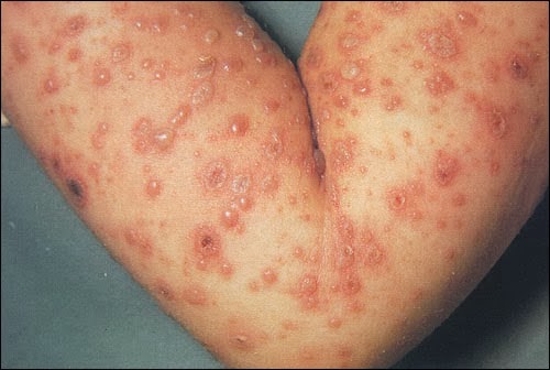 cara menghilangkan herpes