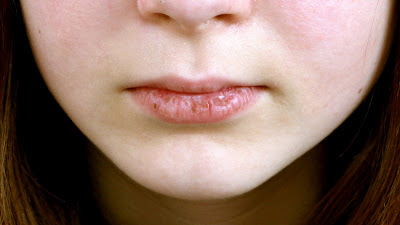 10 reason of dry mouth,dry mouth treatment,dry mouth remedy