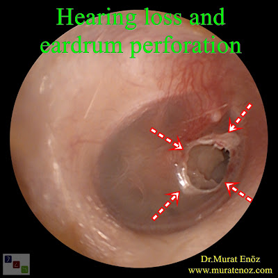 Hearing loss and eardrum perforation