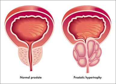 Enlarged Prostate