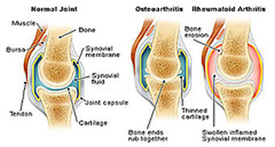 Cara Ubat Lutut Bengkak - Perubatan a