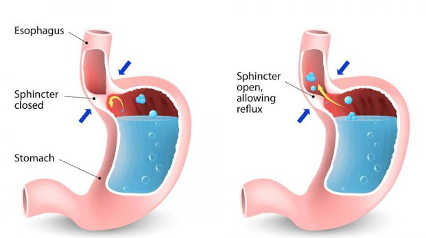 এসিড রিফ্লাক্স সম্পর্কিত তথ্য