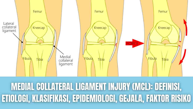 Medial Collateral Ligament Injury (MCL): Definisi, Etiologi, Klasifikasi, Epidemiologi, Gejala, Faktor Risiko Definisi Medial Collateral Ligament (MCL) adalah pita datar (flat band) jaringan ikat yang membentang dari epikondilus medial femur ke kondilus medial tibia. Memiliki fungsi untuk memberikan stabilitas valgus pada sendi lutut. Cedera MCl sering terjadi dalam olahraga, terutama di ski, yang secara data 60 5 cedera lutut saat bermain ski melibatkan MCL.    Etiologi Mekanisme cedera MCL mungkin melibatkan putaran, pemotongan, atau puntiran secara tiba-tiba. Cedera MCL juga dapat terjadi akibat pukulan langsung ke lutut lateral yang menyebabkan tekanan valgus yang ekstrem. Cedera pada MCL dapat diisolasi tetapi lebih sering terjadi bersamaan dengan cedera pada struktur lutut lainnya. Misalnya "unhappy triad" terdiri dari cedera bersamaan pada MCL, ligamen anterior (ACL), dan meniskus medial.    Klasifikasi American Medical Association mengklasifikasikan cedera MCL menjadi 3 tingkatan: Derajat I : Menunjukkan hanya beberapa serat robek minimal tanpa kehilangan integritas ligamen (cedera regangan).  Derajat II : Ada robekan sebagian dari MCL. Derajat III : Menunjukkan kerusakan total ligamen yang parah. Dengan melakukan valgus stress test pada fleksi lutut 30 derajat, pasien dengan cedera MCL grade (derajat) III mengalami kelemahan lutut valgus.  Dalam sebuah studi yang dilakukan Hughston et al. membagi cedera derajat III ke dalam kategori 3-5 mm, 5-10 mm, dan 10 mm berdasarkan jumlah peningkatan ruang lutut medial selama uji stres abduksi lutut. Meskipun demikian, klasifikasi klinis yang diusulkan untuk cedera MCL relatif didasarkan pada opini subjektif; selain itu, sejauh ini validitas dan reliabilitasnya belum dinilai dan disetujui.    Epidemiologi Cedera pada ligamen lutut menyumbang sekitar 40% dari semua cedera lutut, dan diantaranya Medial Collateral Ligament Injuries (MCL) adalah yang paling umum.    Gejala Gejala cedera MCL dapat bervariasi berdasarkan sederapa parah robekan. Jika MCL robek, kemungkinan akan mengalami gejala seperti:  Mendengar suara letupa pada saat cedera Mengalami nyeri pada lutut Memiliki tenderness di sepanjang sisi dalam lutut Mengalami kekakuan dalam pembengkakan pada lutut Merasa seperti lutut akan menyerah jika membebaninya Merasakan sendi lutut terkunci atau terjepit saat menggunakannya    Faktor Risiko Faktor risiko yang meningkatkan terkena cedera MCL meliputi sepak bola, ski, dan pernah mengalami cedera MCL sebelumnya.