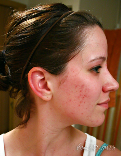red spots acne scars there