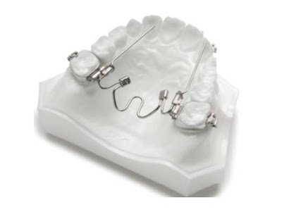 Lợi ích và nguyên tắc khi dùng hàm duy trì sau khi niềng răng