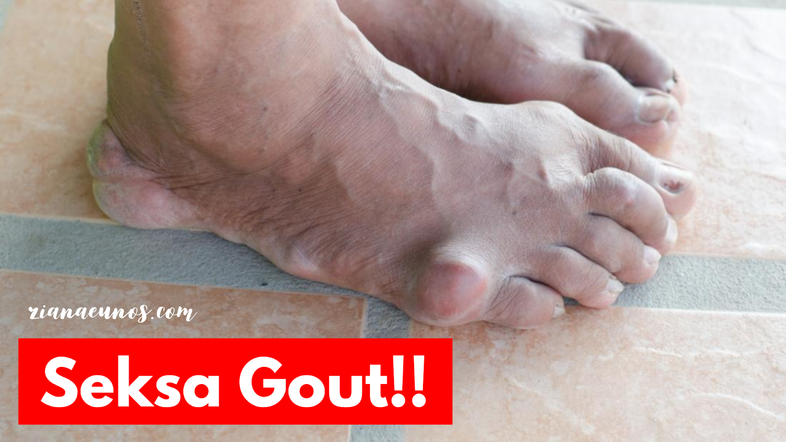 Penyakit Gout Punca Tanda Tanda Dan Set Gout Shaklee Ziana Eunos