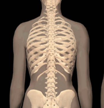scoliosis2