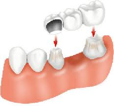 Lắp cầu răng sứ thay thế răng bị mất nên biết