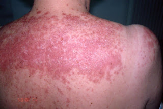 Systemic Erythema Lupus