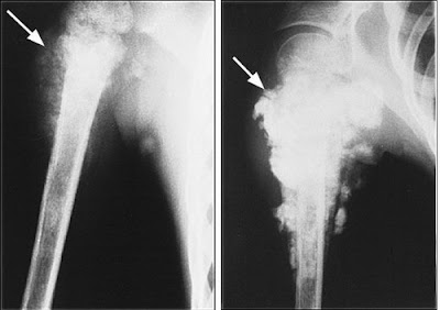 Cách chữa trị bệnh Sarcoma tạo xương 