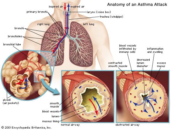 Asthama Disease.