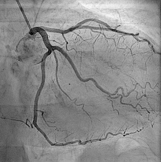 Coronary angiogram