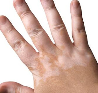 What Are Symptoms of Segmental Vitiligo