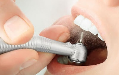 Lấy tủy bọc răng sứ áp dụng khi nào? 2