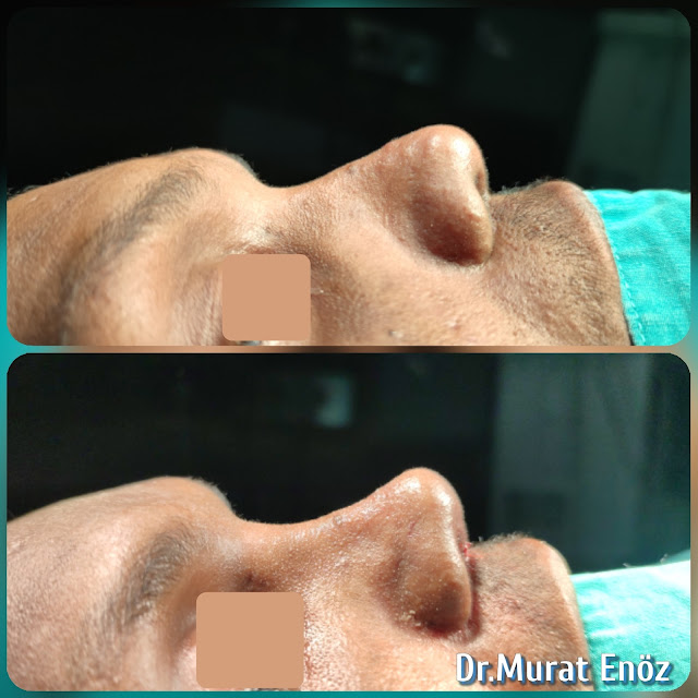 Ethnic Revision Rhinoplasty in Istanbul,Ethnic African Nose Aesthetic, Secondary revision ethnic nose job