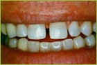Mesa AZ Orthodontist Reasons for Dental Braces