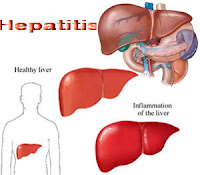 Obat Herbal Penyakit Hepatitis
