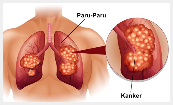 Obat Kanker Paru-Paru Terbaik Herbal