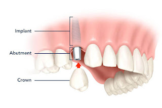 Yếu tố tác động đến giá răng implant-1