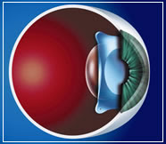 effective for thin-flap LASIK