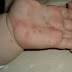 Brote de varicela afecta a residentes en municipio de Vicente Noble