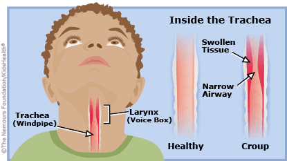 6 langkah mengurangkan croup cough pada bayi - Hearty 