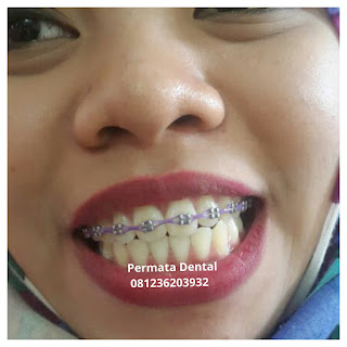 gambar foto behel bracket kawat gigi sebelum dan sesudah perawatan untuk memperbaiki merapikan gigi gingsul gigi miring renggang tonggos berantakan keluar masuk jarang diastema maju mundur tidak rapi tidak beraturan bali denpasar banyuwangi jember tidak rata kocar kacir