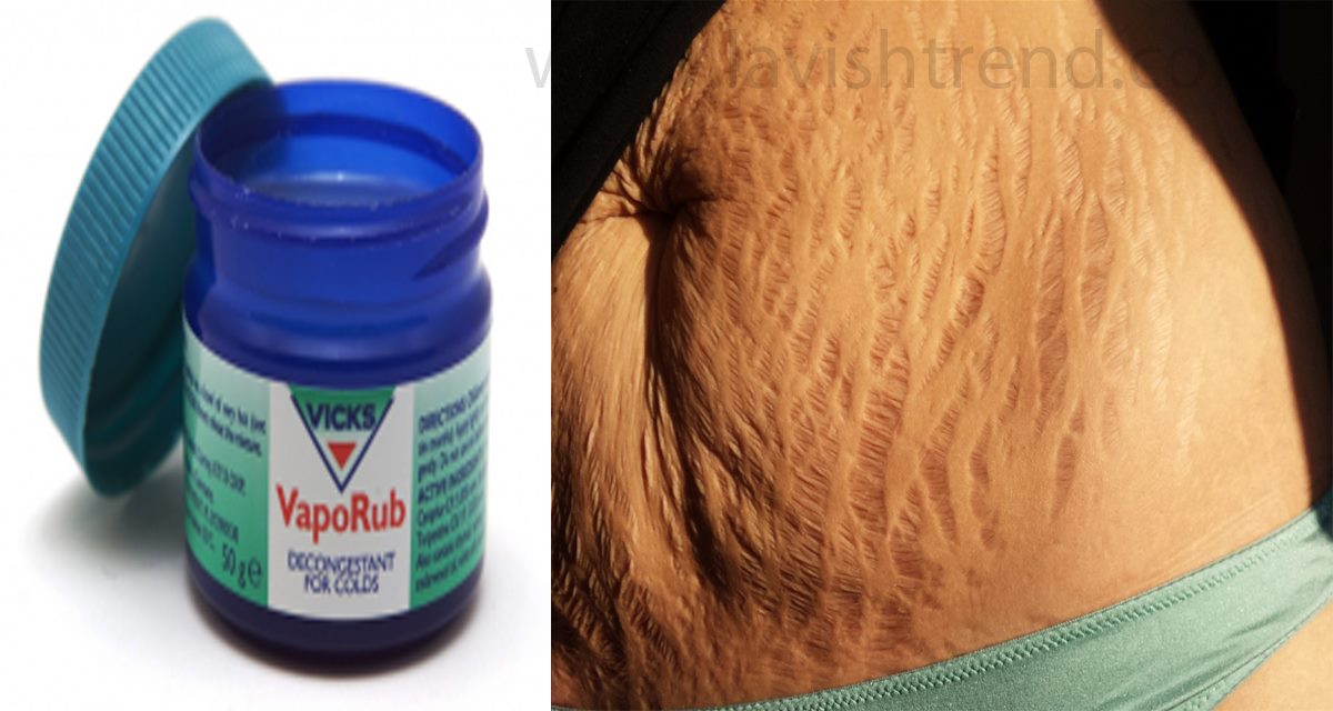 How To Use Vicks Vaporub To Get Rid Of Stretch Marks ...