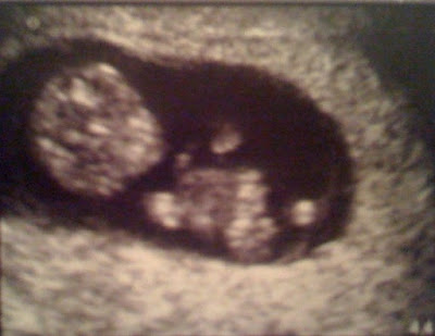 sonogram 5 weeks. the ultrasound machine,