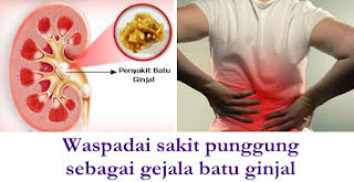 Pencegahan batu ginjal dan obat kencing batu alami