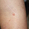 What Does Early Stage Skin Cancer Look Like / Do You Know How To Identify Early Signs Of Skin Cancer Tri City Medical Center : Usually, these abnormal cells arise when ultraviolet light from the sun or tanning beds damages their dna.