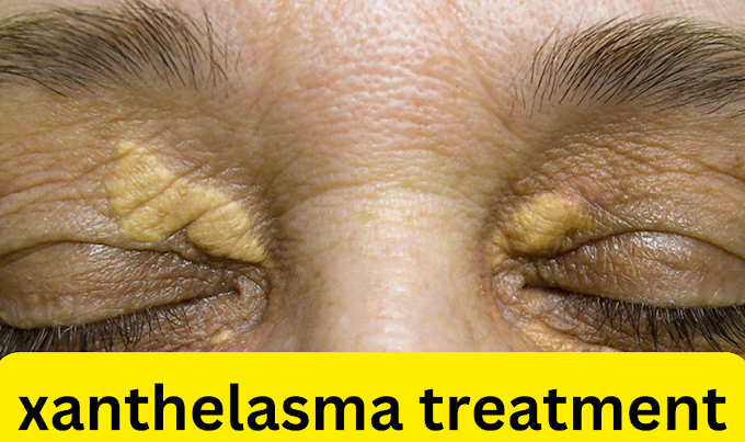 Xanthelasma Removal Cream