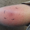 What Do Spider Bites Look Like In The Beginning : Common Spider Bite Symptoms Household Wolf Spider Everyday Health - Spider bites are uncommon, and many diagnosed spider bites are actually bites from other black widow bites look like a pinprick.