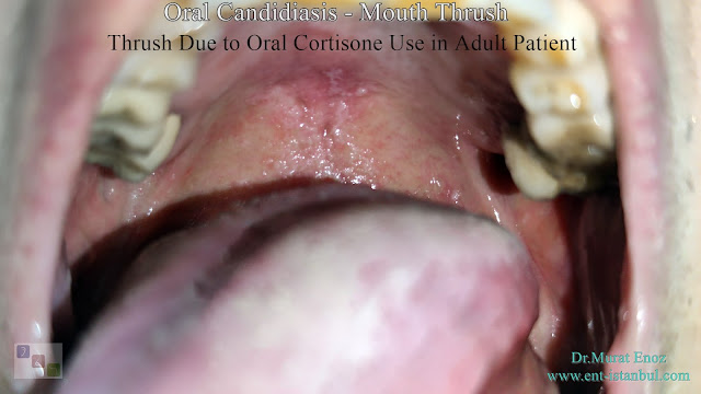 Oral candidiasis, Mouth thrush, Candida infection of soft palate,Oral thrush, Yeast infection in mouth