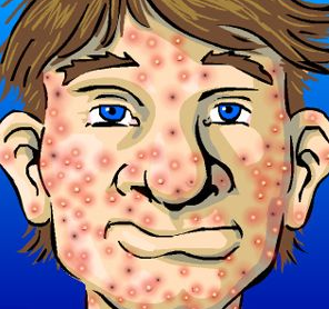 acne 10 Takdir Keturunan Yang Sulit Dihilangkan