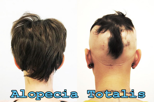 alopecia totalis,alopecia areata totalis,alopecia totalis treatment,alopesi totalis,alopecia capitis totalis,alopecia totalis universalis,alopecia totalis and universalis,treatment for alopecia universalis,alopecia totalis hair regrowth,alopecija totalis,homeopathic treatment for alopecia totalis,cure for alopecia universalis,alopecia totalis regrowth,alopecia totalis in female,areata totalis,alopecia areata totalis and universalis,alopecie totalis,alopecia totalis nhs,alopecia totalis cure,alopecia totalis behandling,alopecia totalis regrowth signs,alopecia cranialis totalis,alopecia sub totalis,childhood alopecia totalis