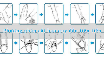 Phương pháp cắt bao quy đầu không đau tiên tiến nhất - 2