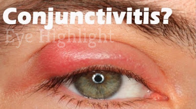 The Eye Conjunctivitis Continue? Could Be Experienced 5 This Disease!