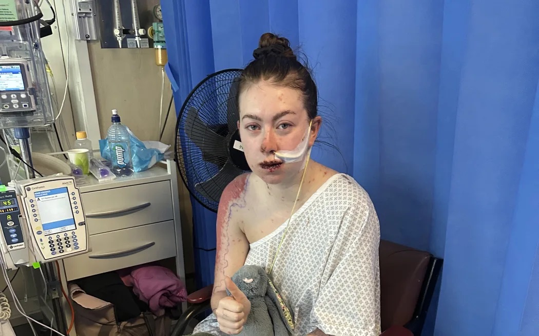 Charlotte đã phải nằm viện 30 ngày tại Bệnh viện Palmerston North sau phản ứng. Ảnh: Được cung cấ