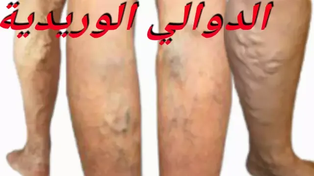 توسع الأوردة في الساق