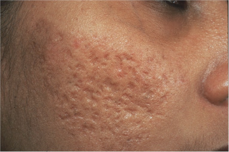 Acne Free Treatment: Acne Scar Removal