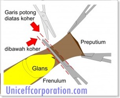 potong-konfensional-300x245